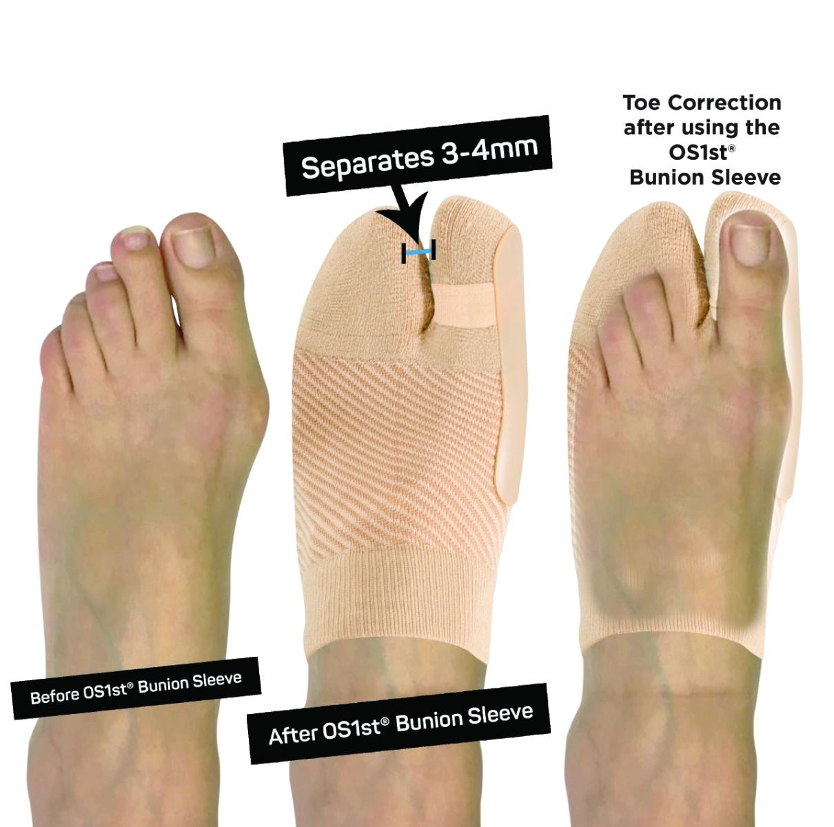 OS1 BUNION BRACING SLEEVE photo